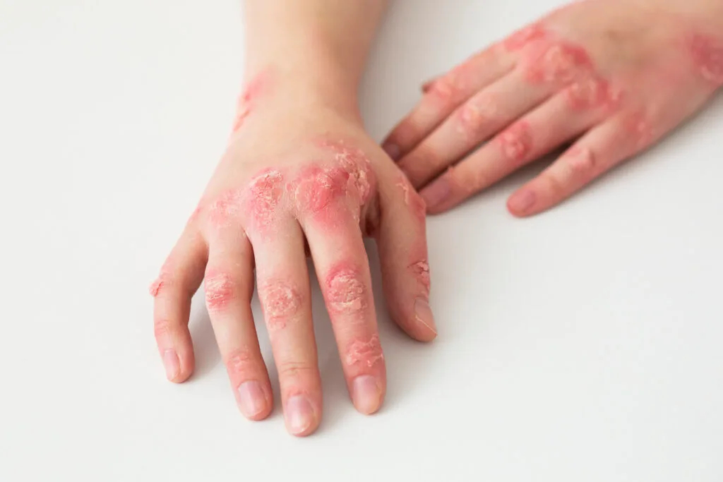 Dermatitis de contacto