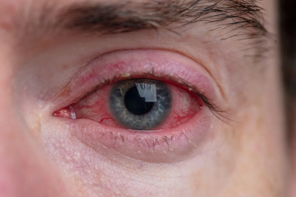 Dermatitis palpebral