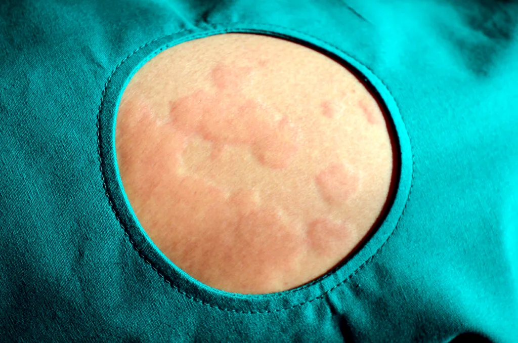 Urticaria y angioedema​